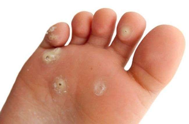 Occhio Di Pernice Cure E Rimedi Naturali Per Eliminarlo